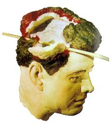 Robert Groden version of Kennedy head wound