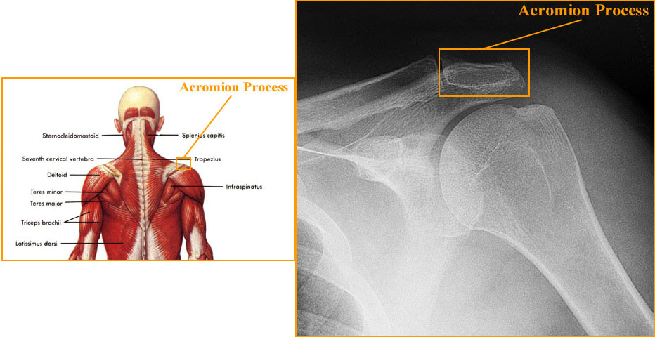 Акромион лопатки фото